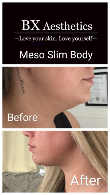 Fat Reduction under the chin