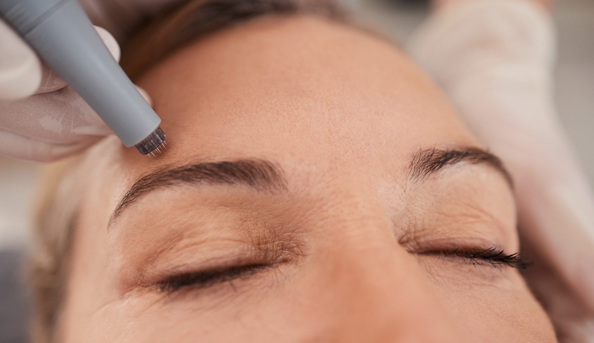 Micro-needling Treatments at BX Aesthetics Camberley Micro-Needling, Hyaluronic-Acid, Micro-injections Camberley. Anti-ageing Camberley RF treatment, Acne Treatment, Collagen induction therapy