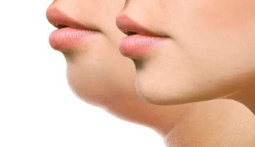 Double Chin Treatments