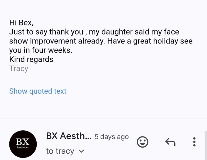 Anti-wrinkle Review Camberley Botox Frimley, Anti-wrinkle Review, Anti-ageing Treatment near me, botox results Camberley, Anti-wrinkle feedback.