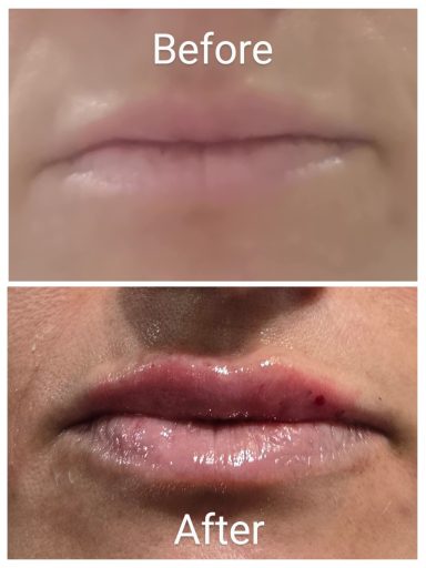 Lip Filler Before & After