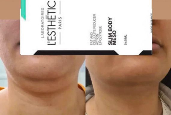 Fat Reduction Chin