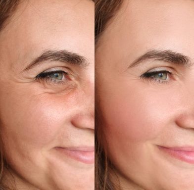 Anti-wrinkle Treatments