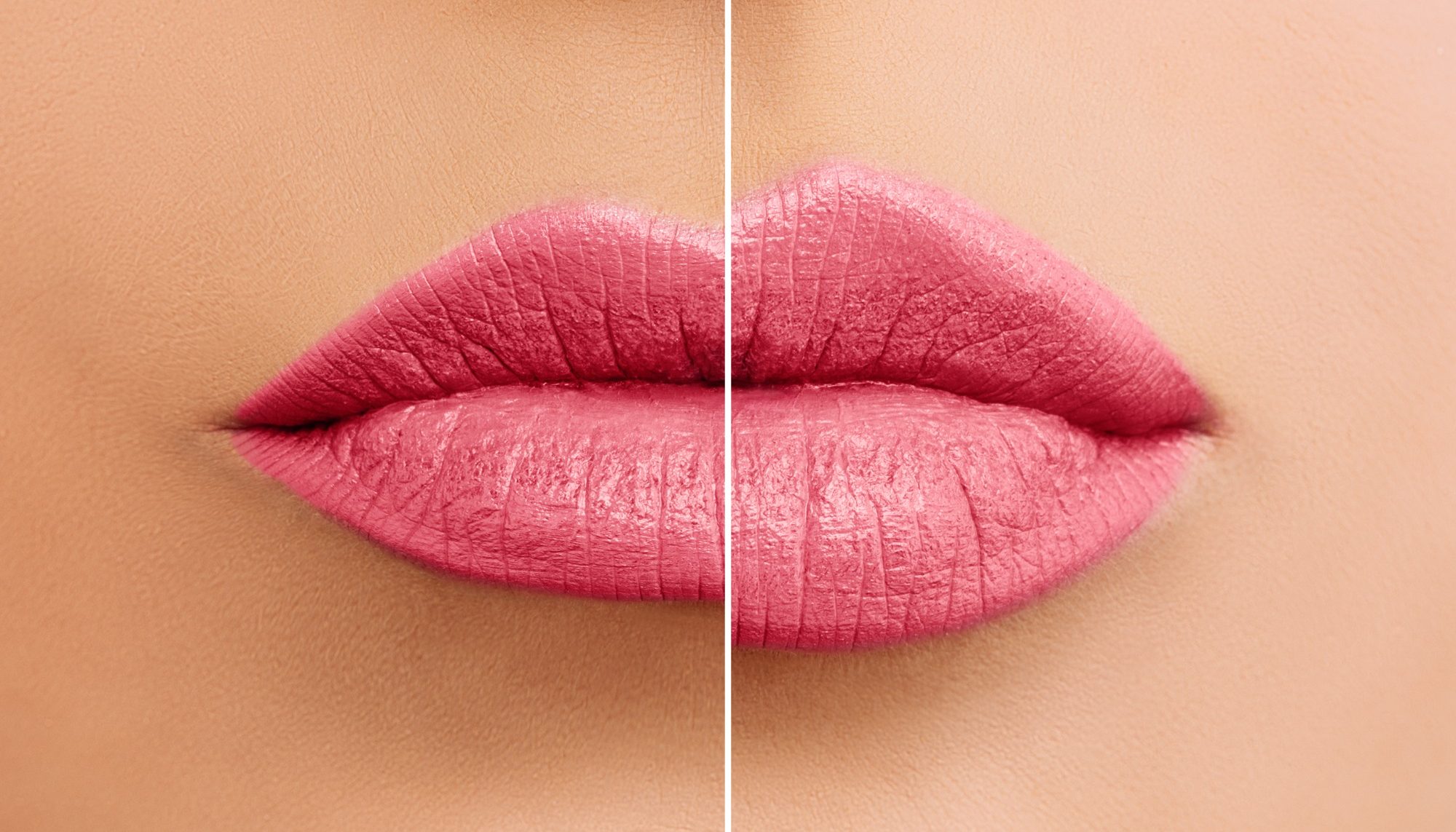 Dermal Filler Camberley BX Aesthetics - Lip Filler Lip Filler, Non surgical Rhinoplasty Frimley, Cheek Filler Camberley, Jaw Filler, Tear Trough Filler near me, Nose Filler